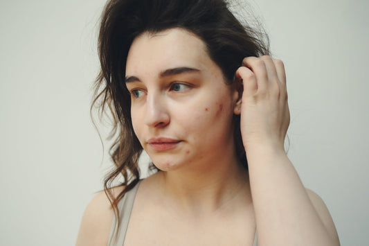 A Teenager's Guide to Tackling Acne with Simple Lifestyle Changes