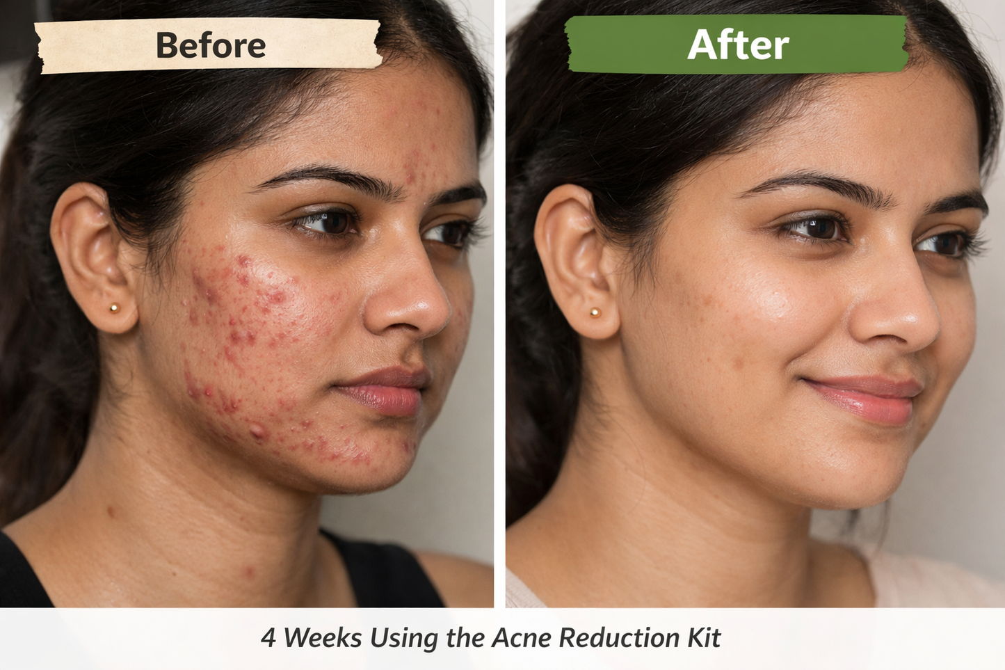 ClearSkin  Acne Reduction Kit