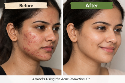 ClearSkin  Acne Reduction Kit